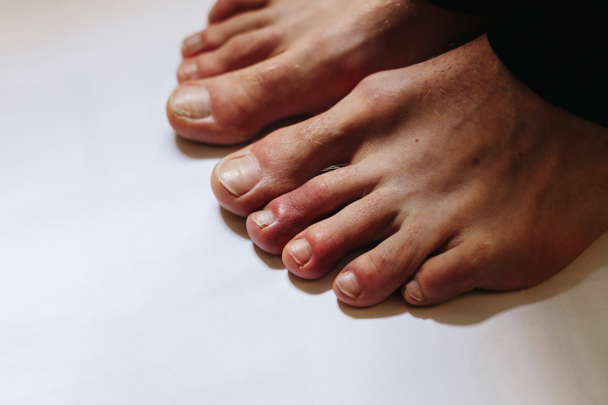 COVID toes, Painful red and purple bumps that tend to occur at the tips of the toes 