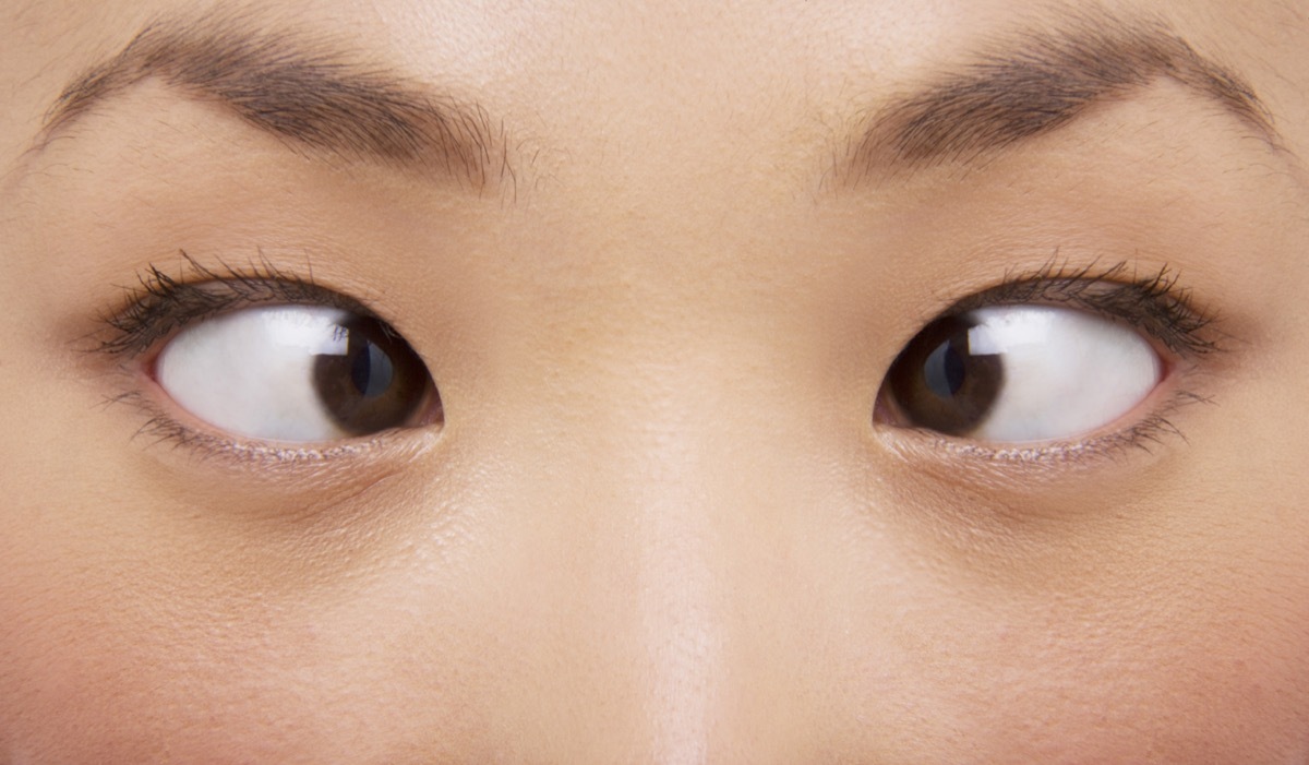 young asian woman with crossed eyes