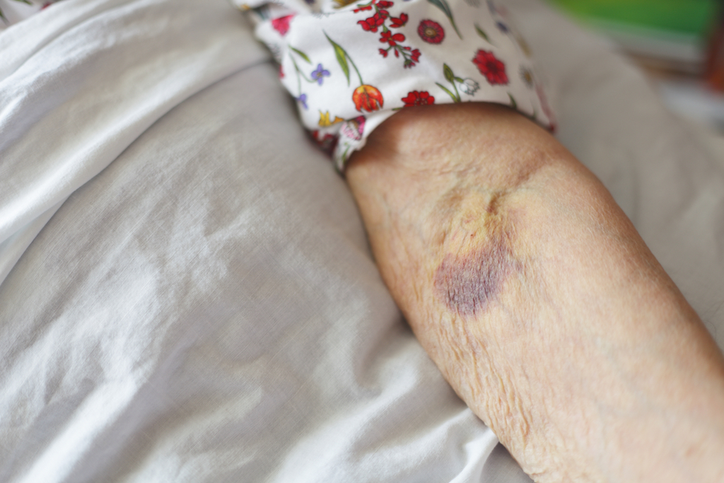 old woman with a bruise on her arm