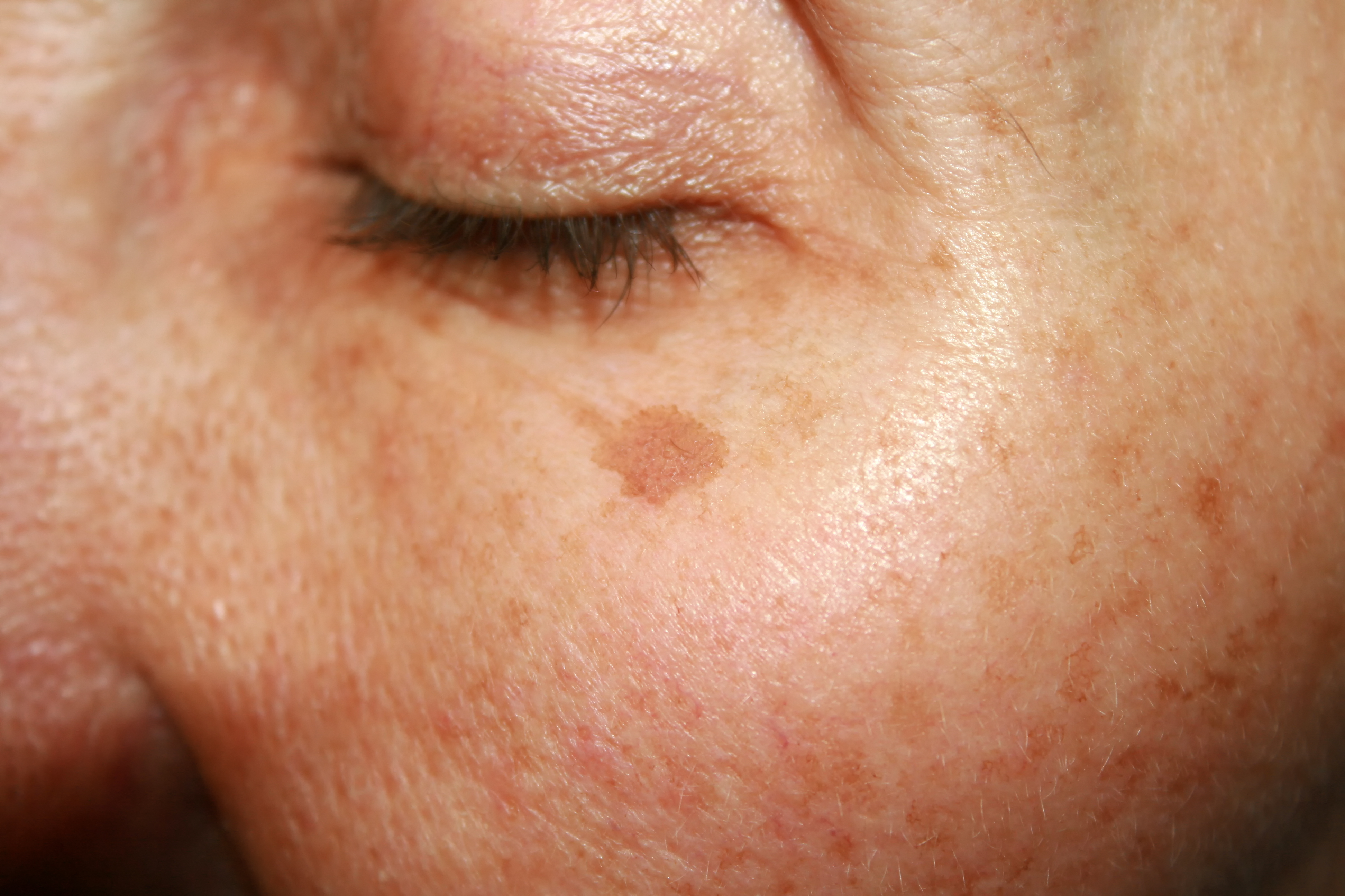 closed eye with an age spot, healthy skin after 40