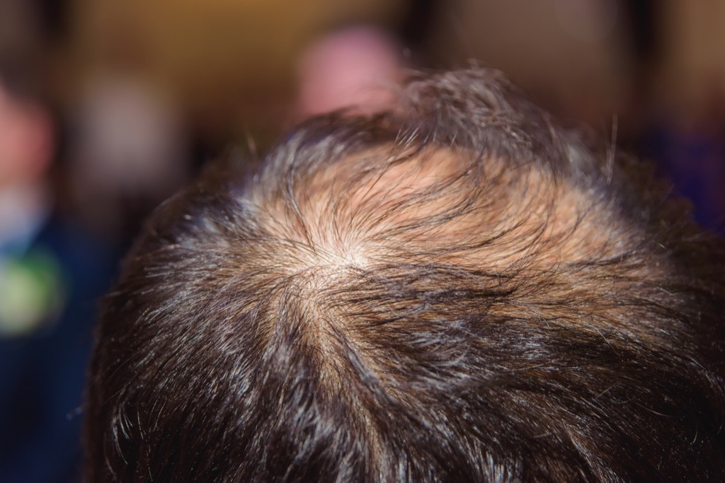 Alopecia Hair Thinning Signs Your Hair Will Go Gray