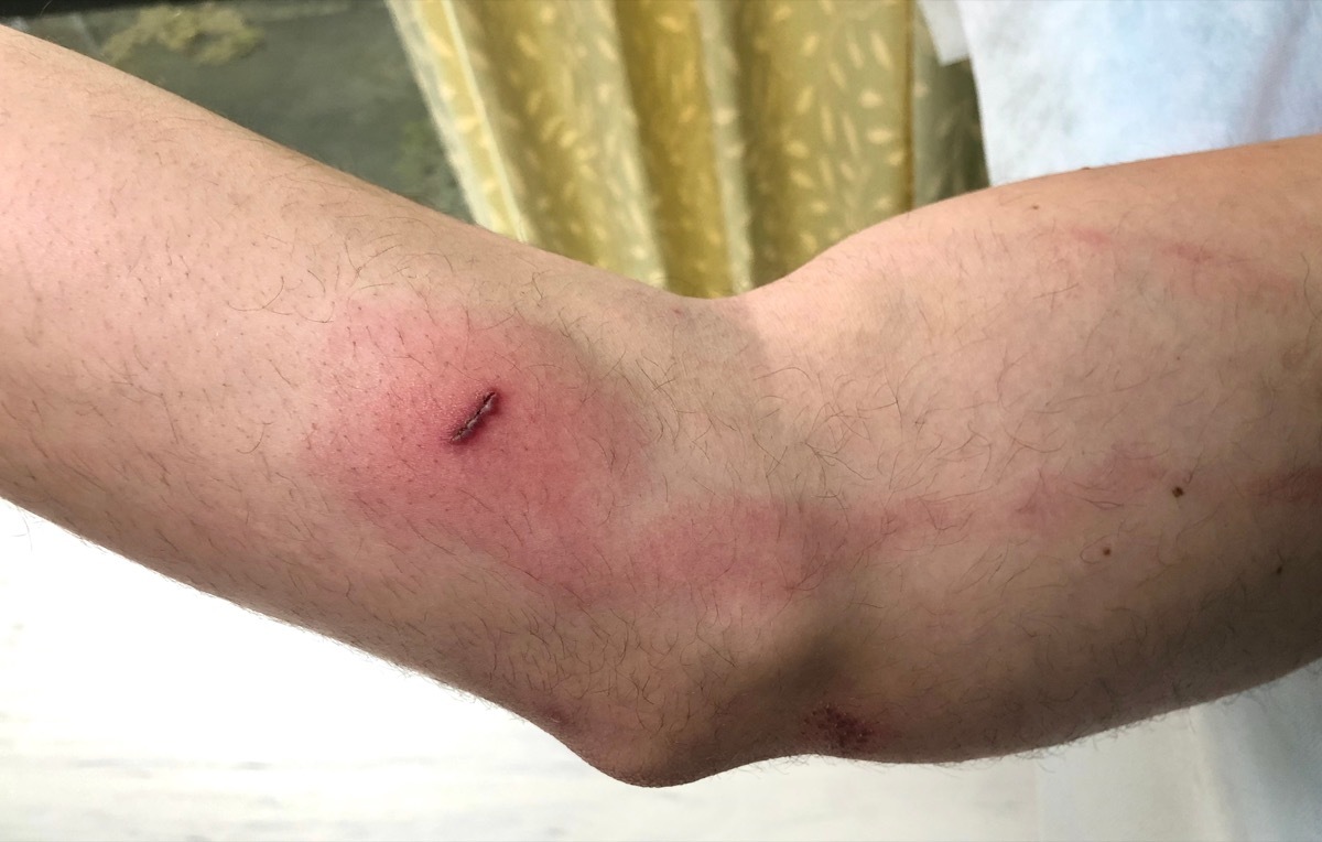 Infectious lymphangitis from a bite wound red streak on arm