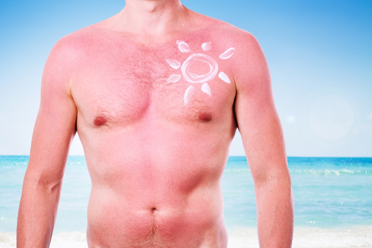 Man making himself a sun-shaped sunburn tattoo
