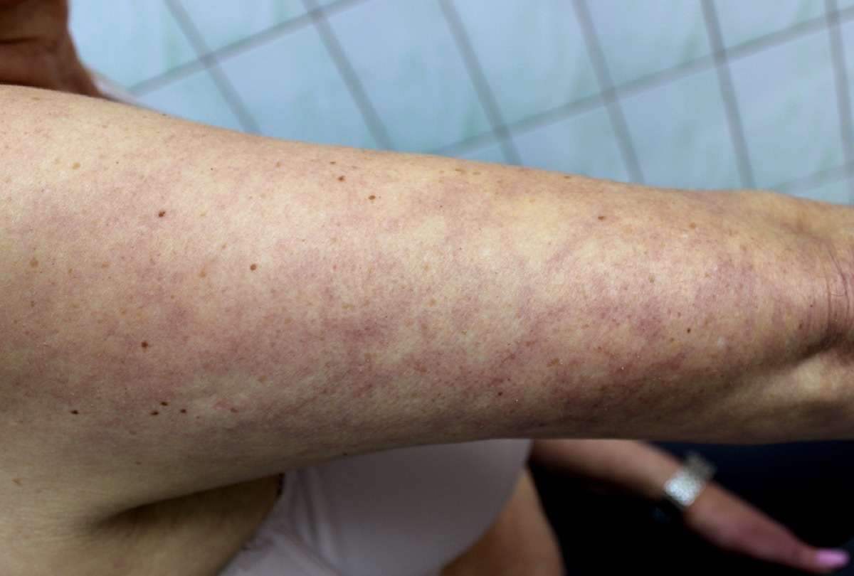 livedo rash on woman's arm
