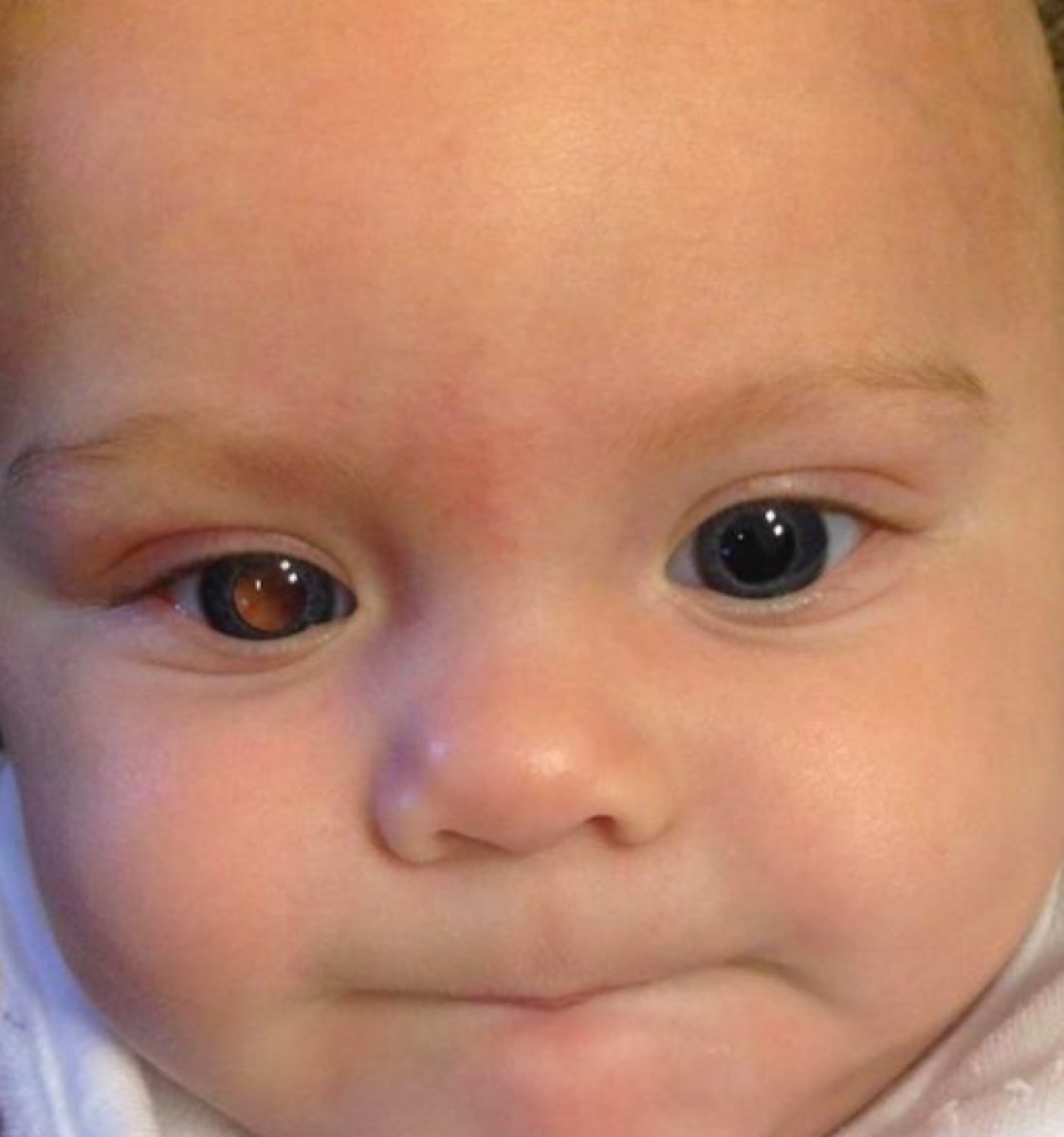 Asher Rock retinoblastoma eye glow